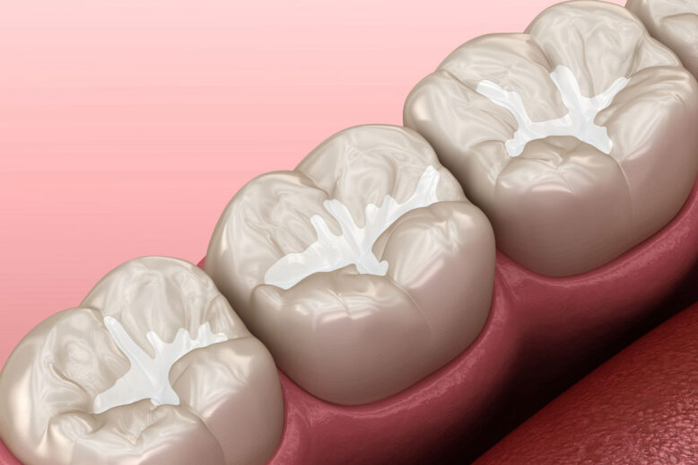 richmond-dental-sealants