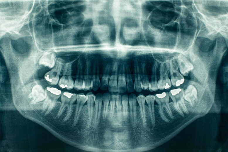 panorex-x-ray-richmond