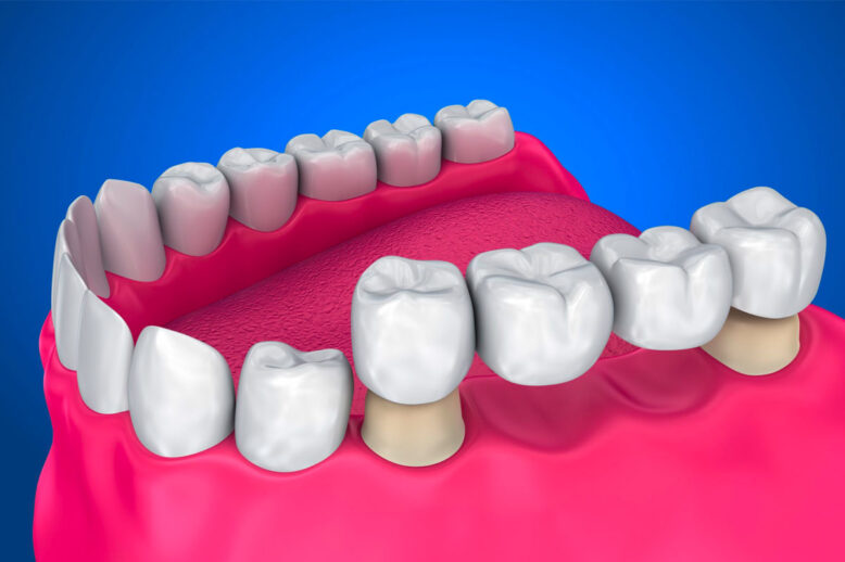 dental-bridges