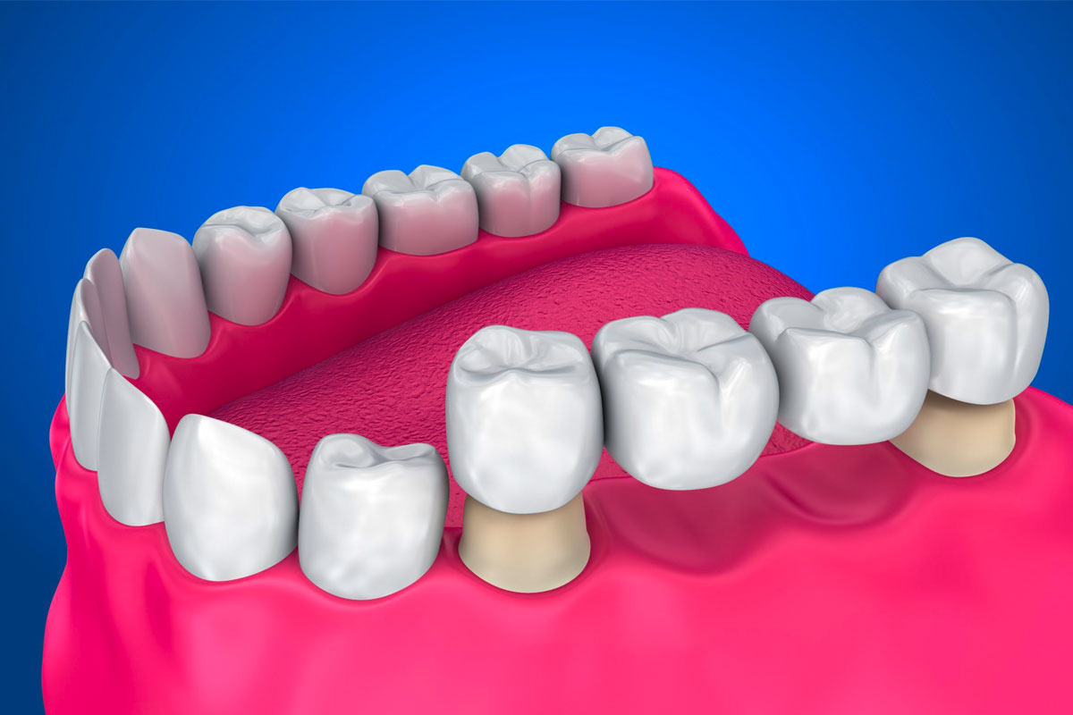 dental-bridges