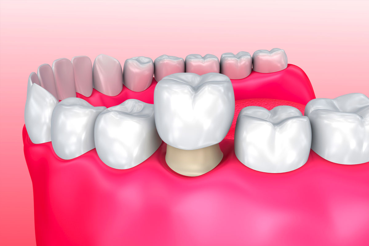 dental-crowns