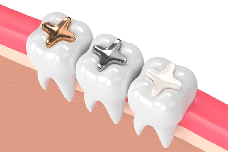 dental-fillings