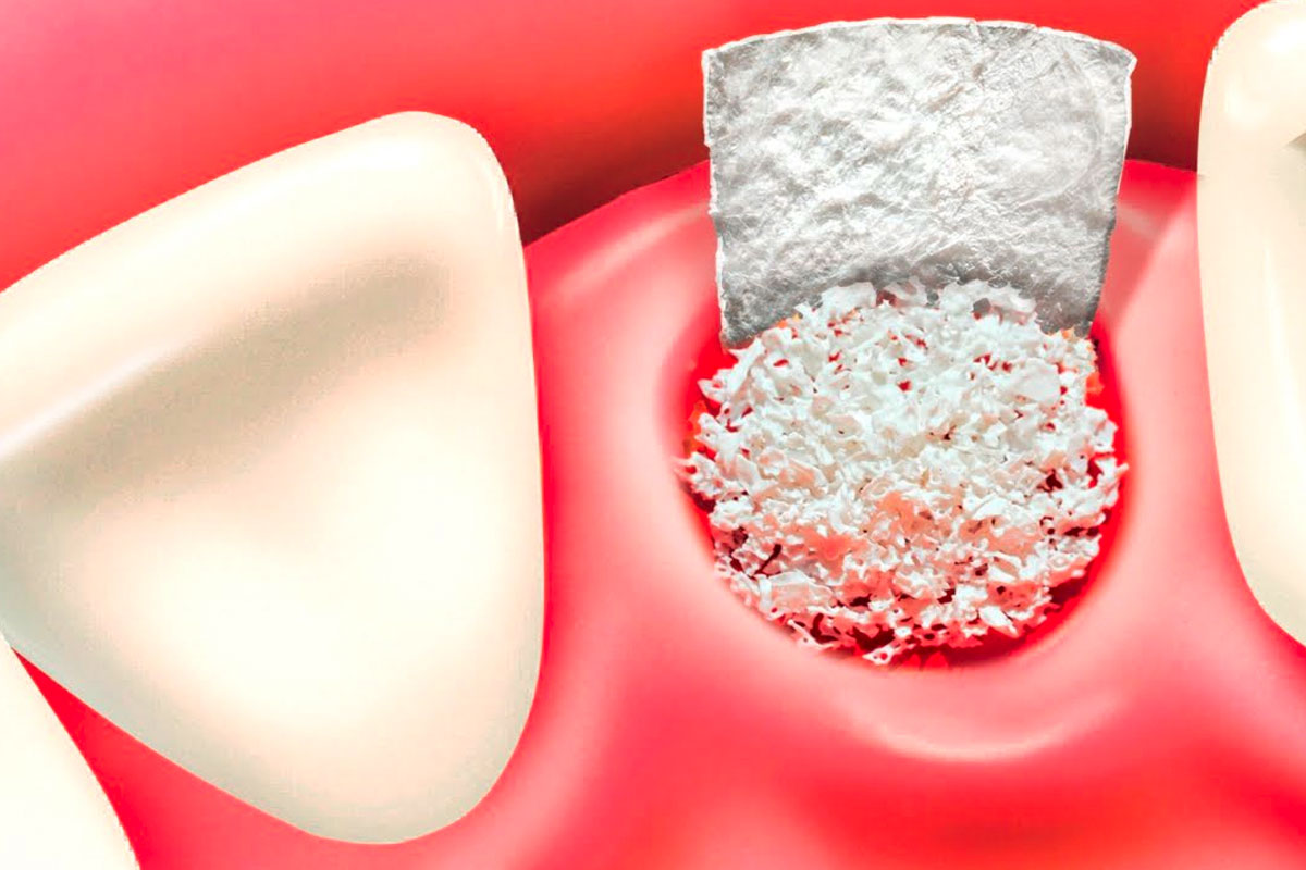 dental-graft
