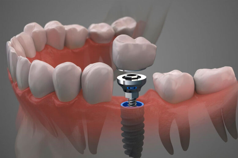 dental-implants