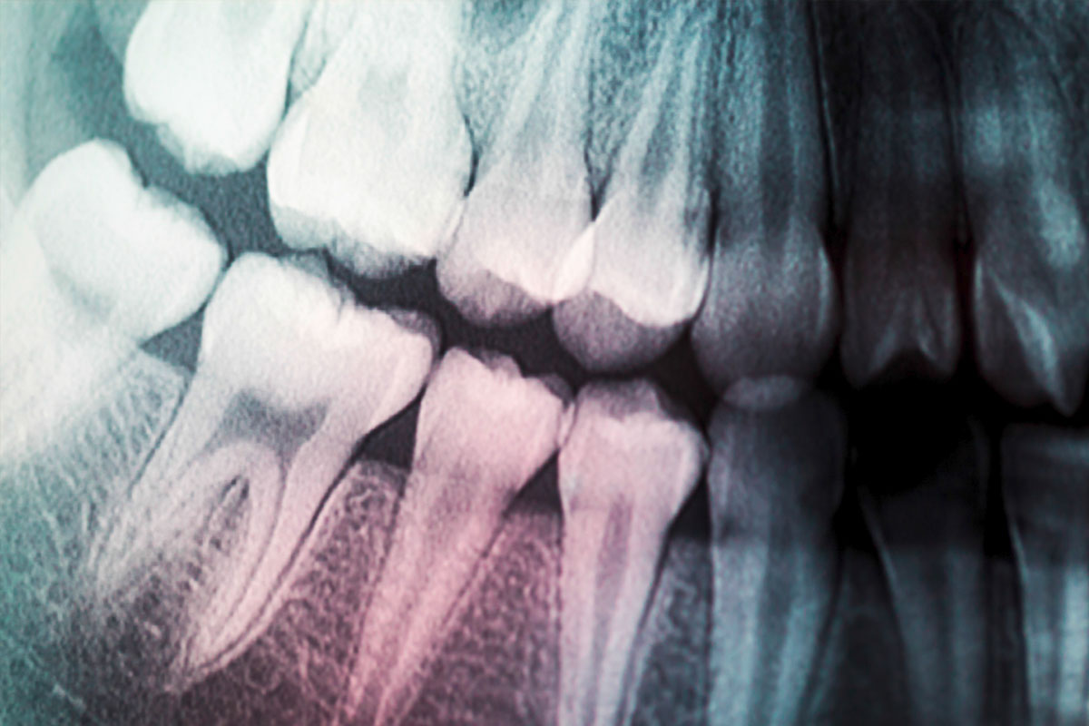 dental-xrays