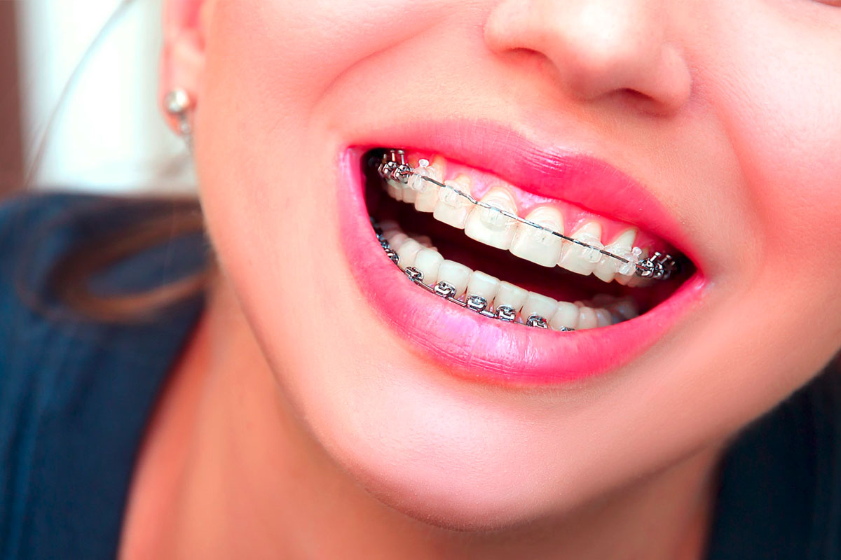 dntal-braces
