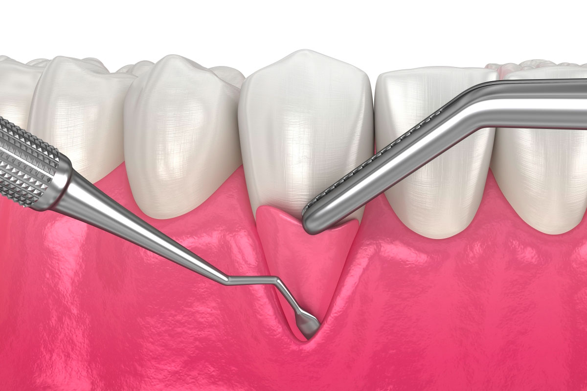 Free Gingival Graft Richmond Dental Centre Free Gingival Graft Richmond Dental Centre