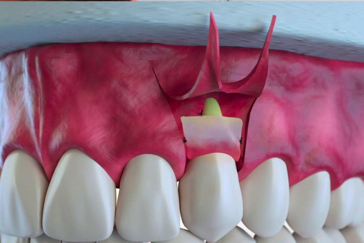 Connective Tissue Graft - Richmond Dental Centre