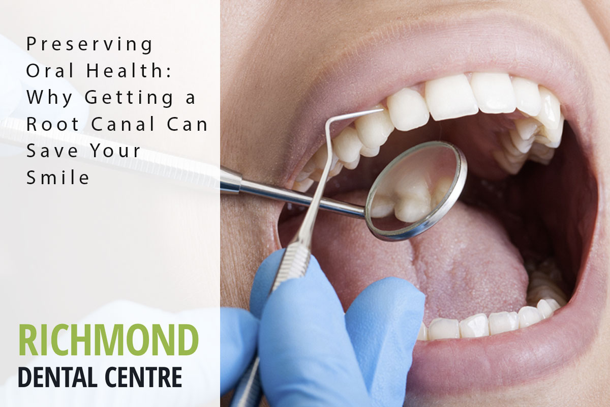 richmond-blog-root-canal root canal