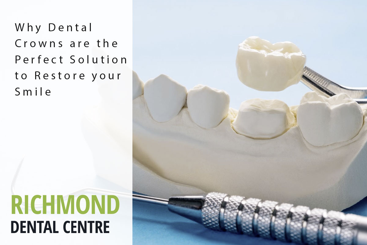 richmond-blog-crowns dental crowns