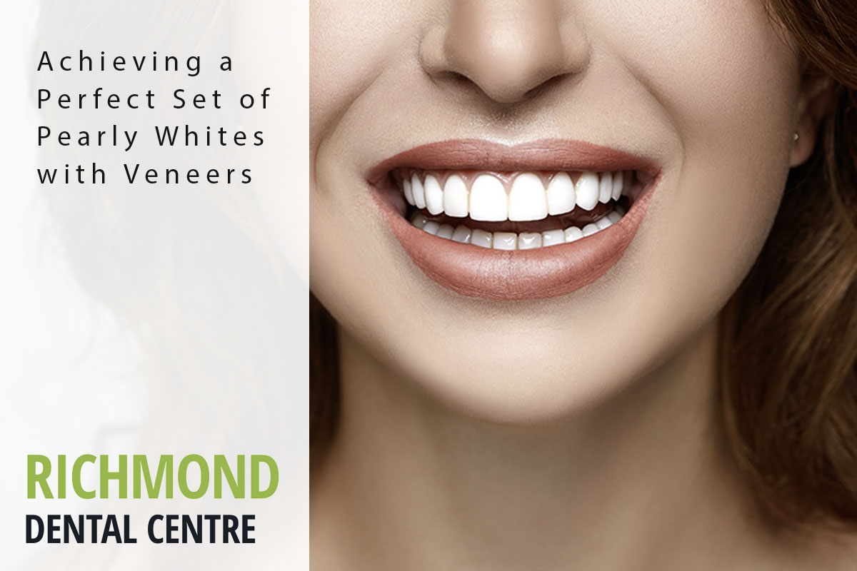 richmond-blog-veneers veneers